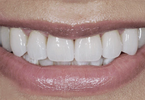 SSD Additional Images Veneers After