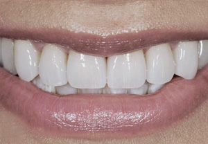 Veneers