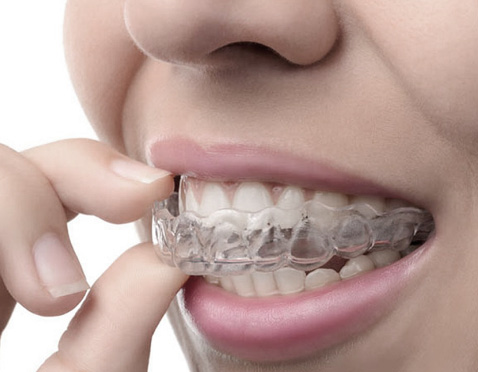 Invisalign clear aligners