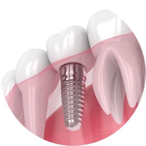 Single tooth implant