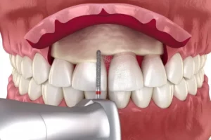 bone grafting