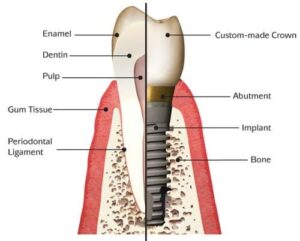 Abutment of implant