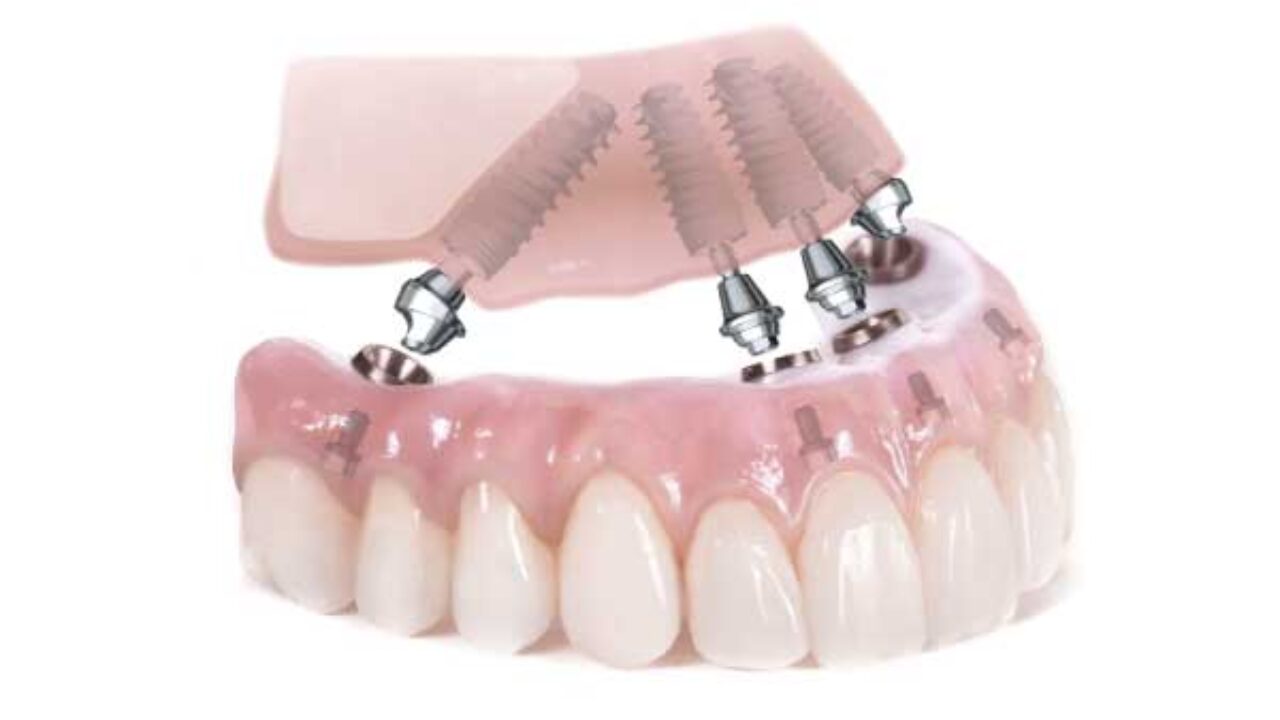 Acrylic vs Porcelain Dental Implants