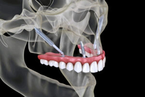 Zygoma dental implants 